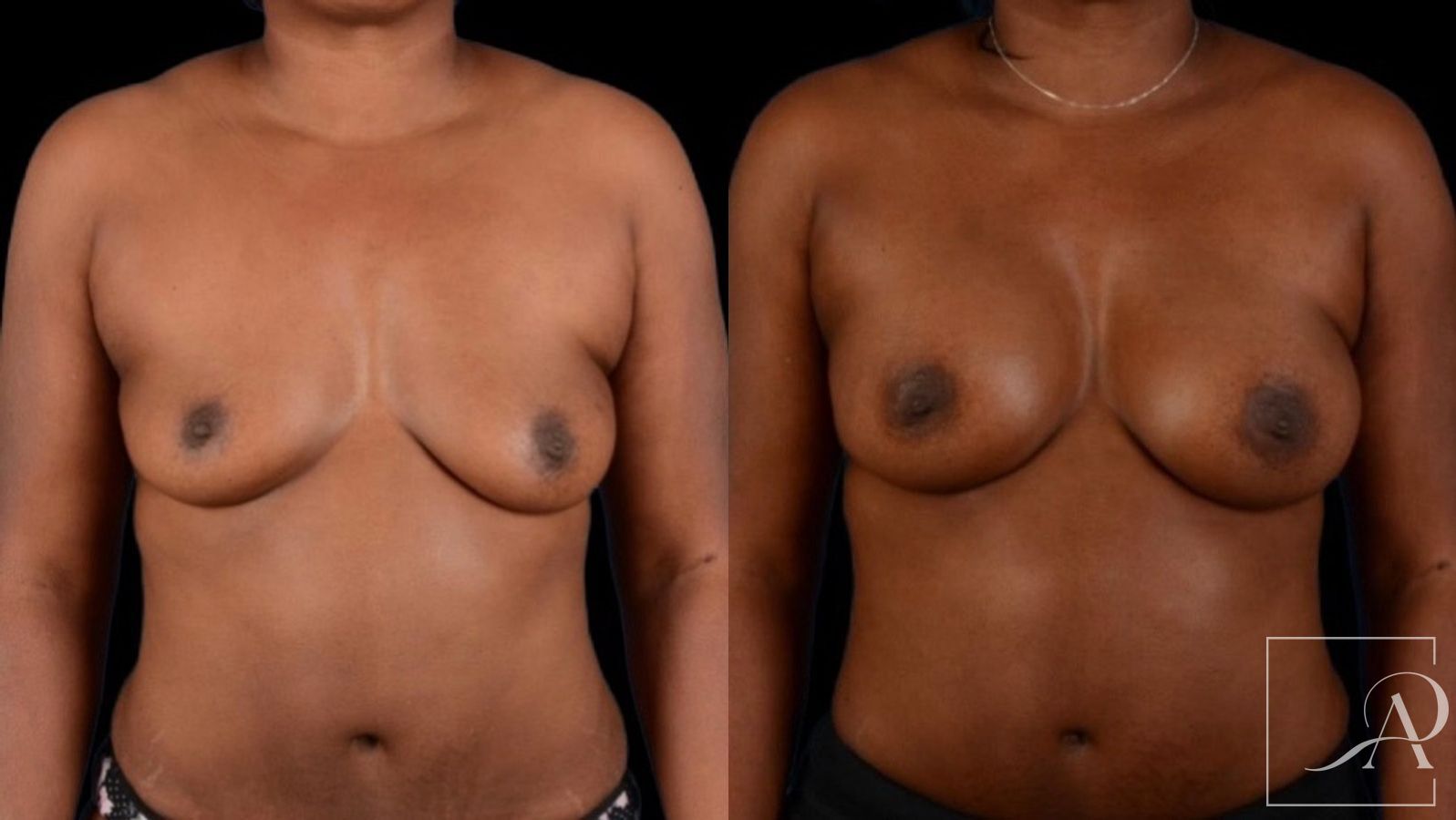 Before and after Breast Augmentation case 43366 - Angle 3