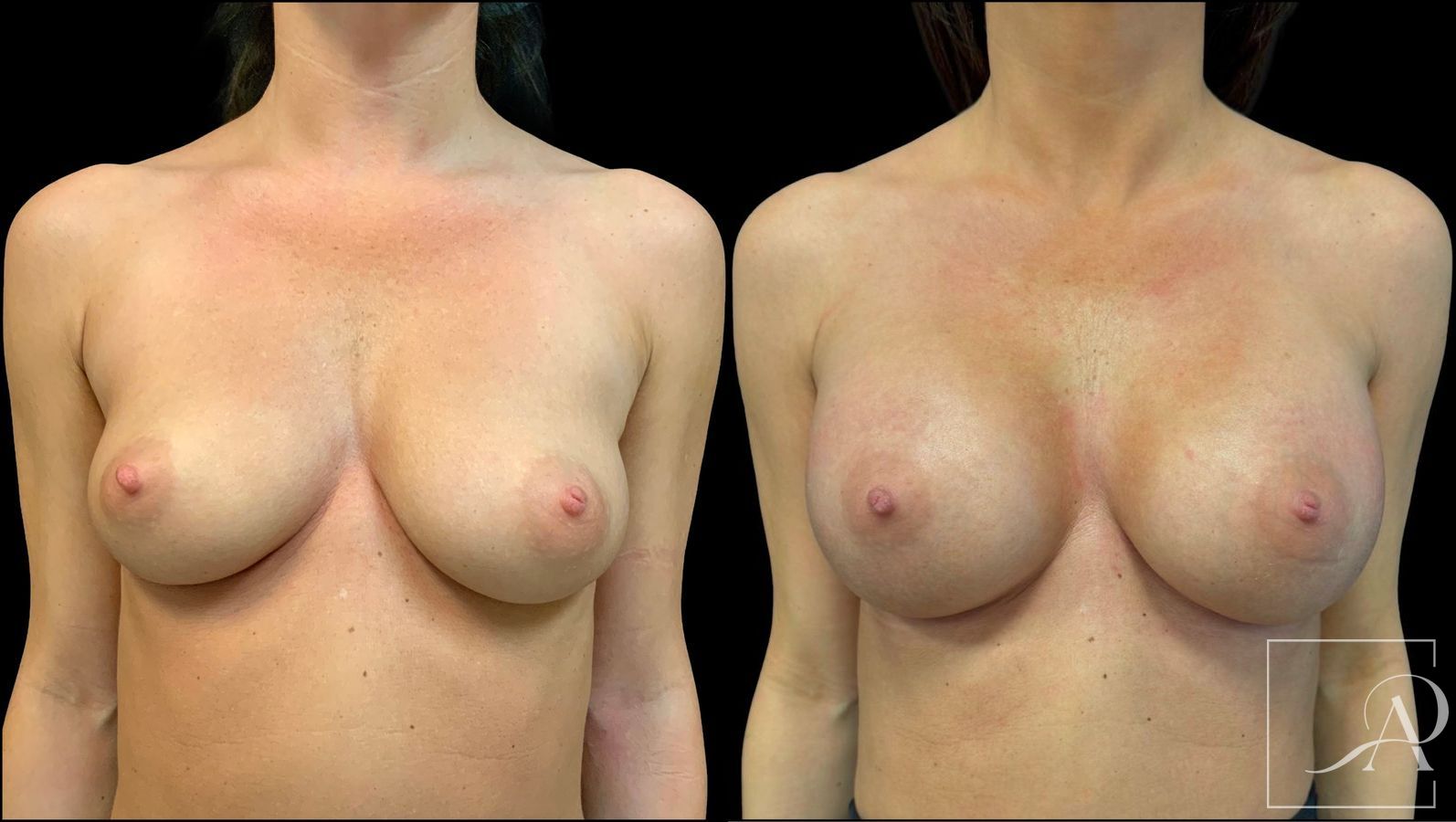 Before and after Breast Augmentation case 43363