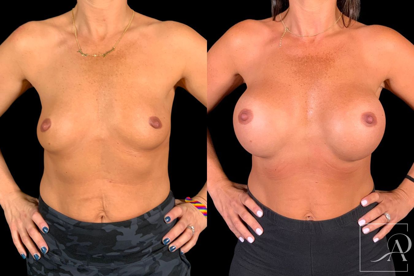 Before and after Breast Augmentation case 49552 - Angle 5