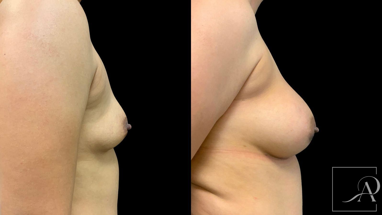 Before and after Breast Augmentation case 43364 - Angle 5