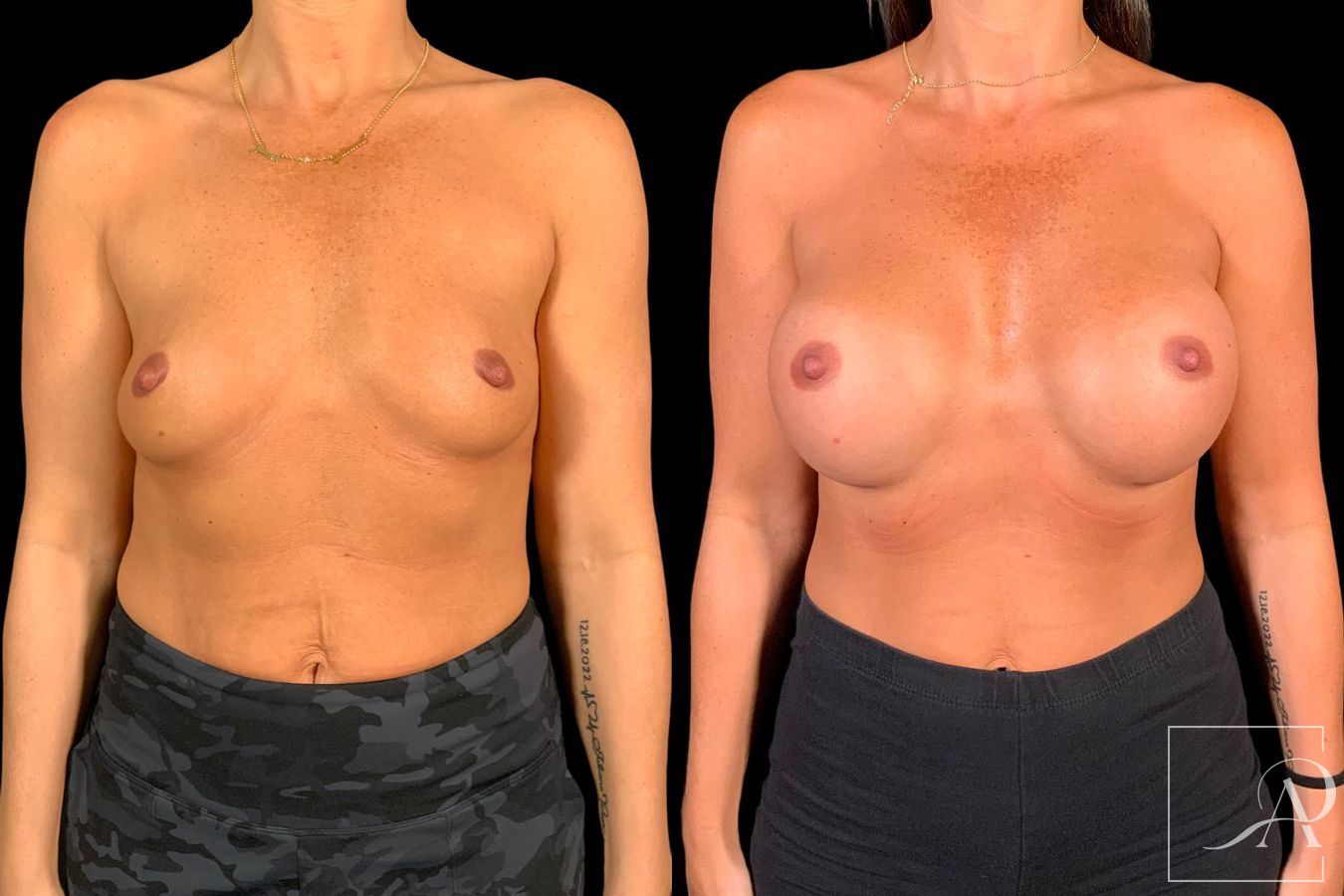 Before and after Breast Augmentation case 49552 - Angle 4