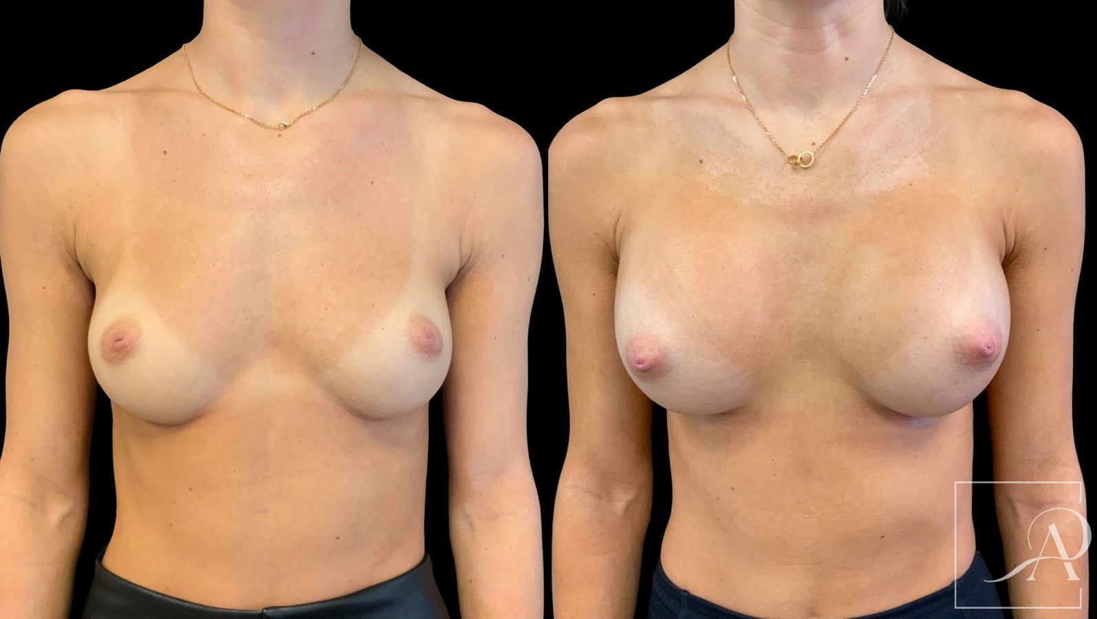Before and after Breast Augmentation case 43365