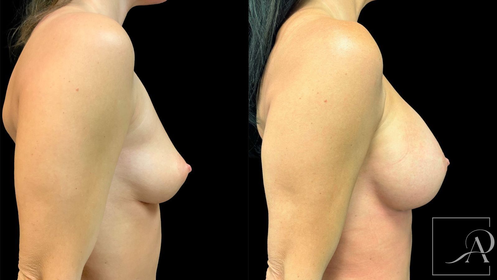 Before and after Breast Augmentation case 43363 - Angle 5