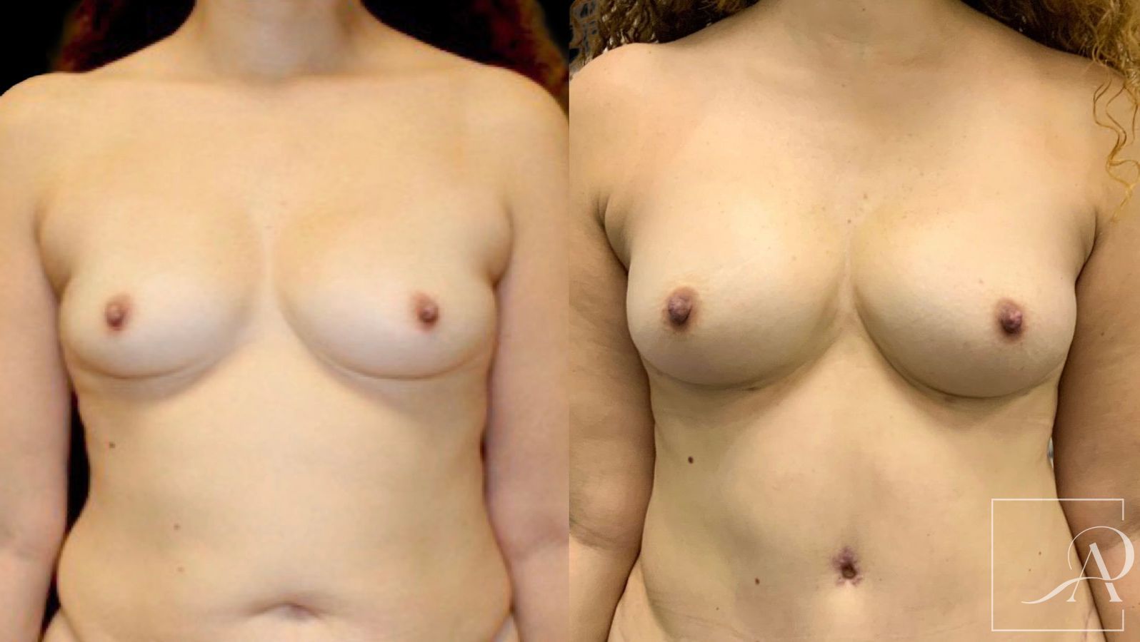 Before and after Breast Augmentation with Fat Grafting case 43386