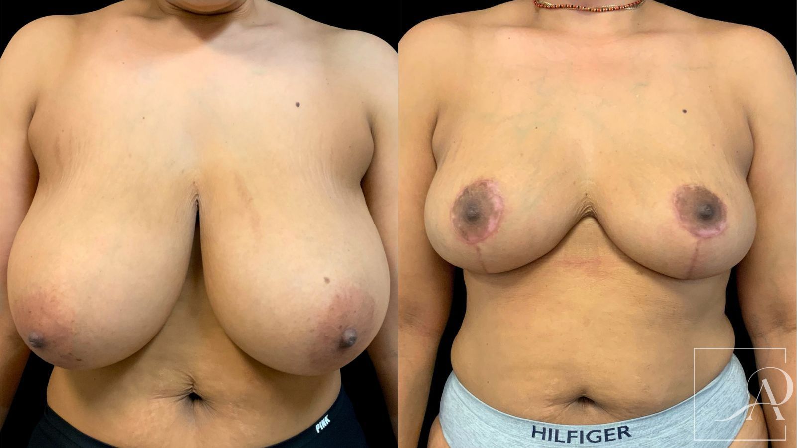 Before and after Breast Reduction case 43396 - Angle 3