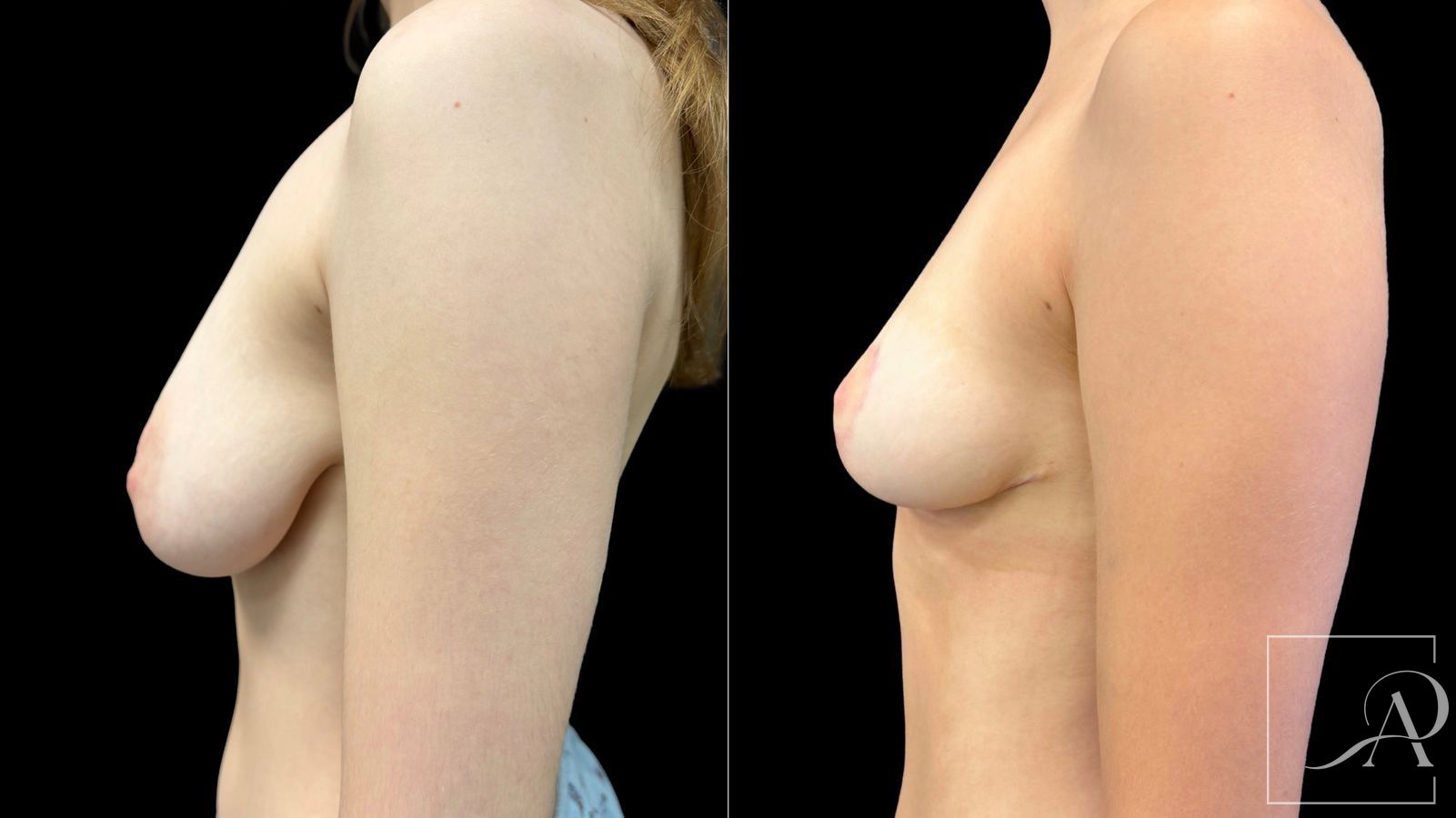 Before and after Breast Reduction case 43397
