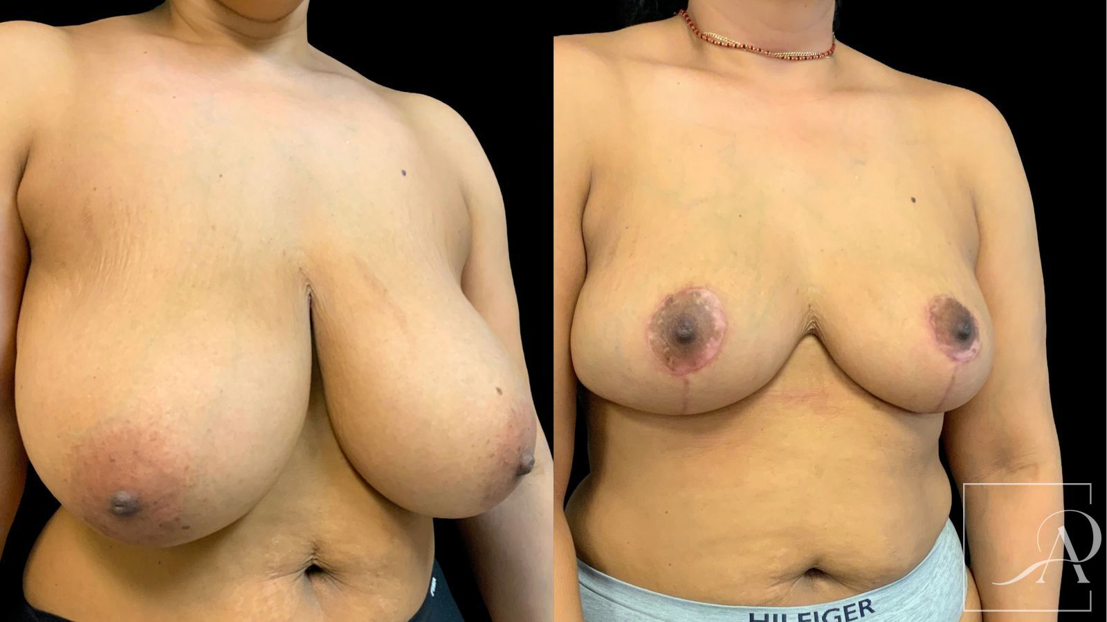 Before and after Breast Reduction case 43396 - Angle 4