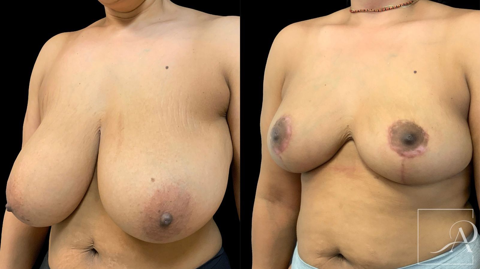 Before and after Breast Reduction case 43396 - Angle 2
