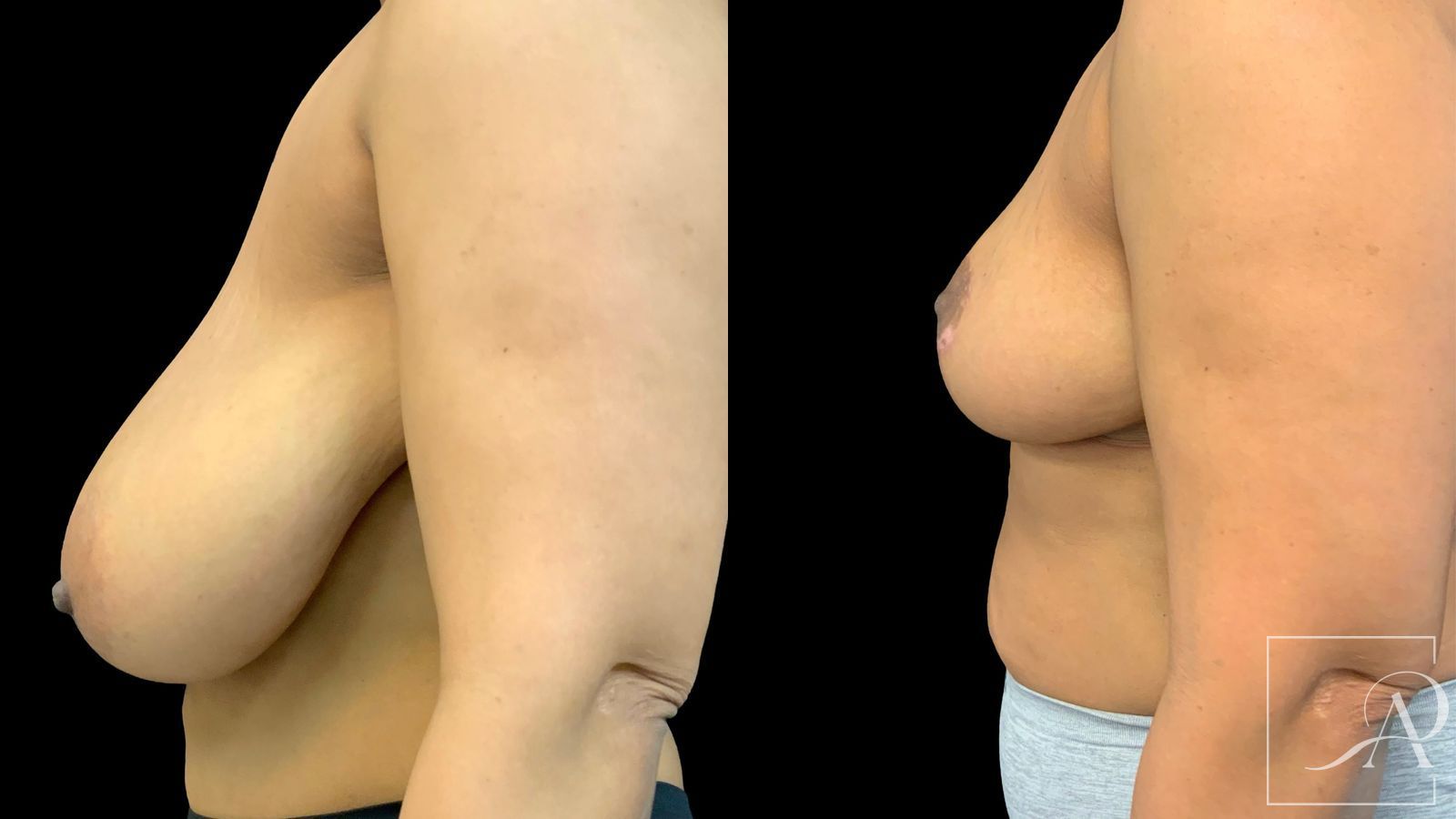 Before and after Breast Reduction case 43396