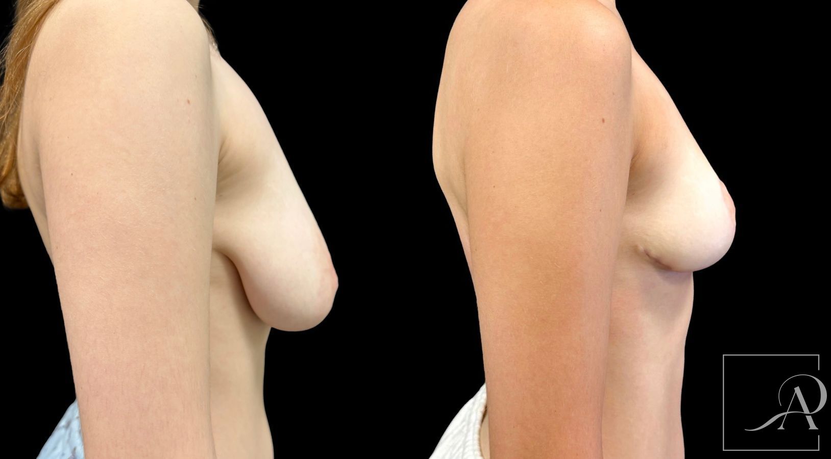 Before and after Breast Reduction case 43397 - Angle 5