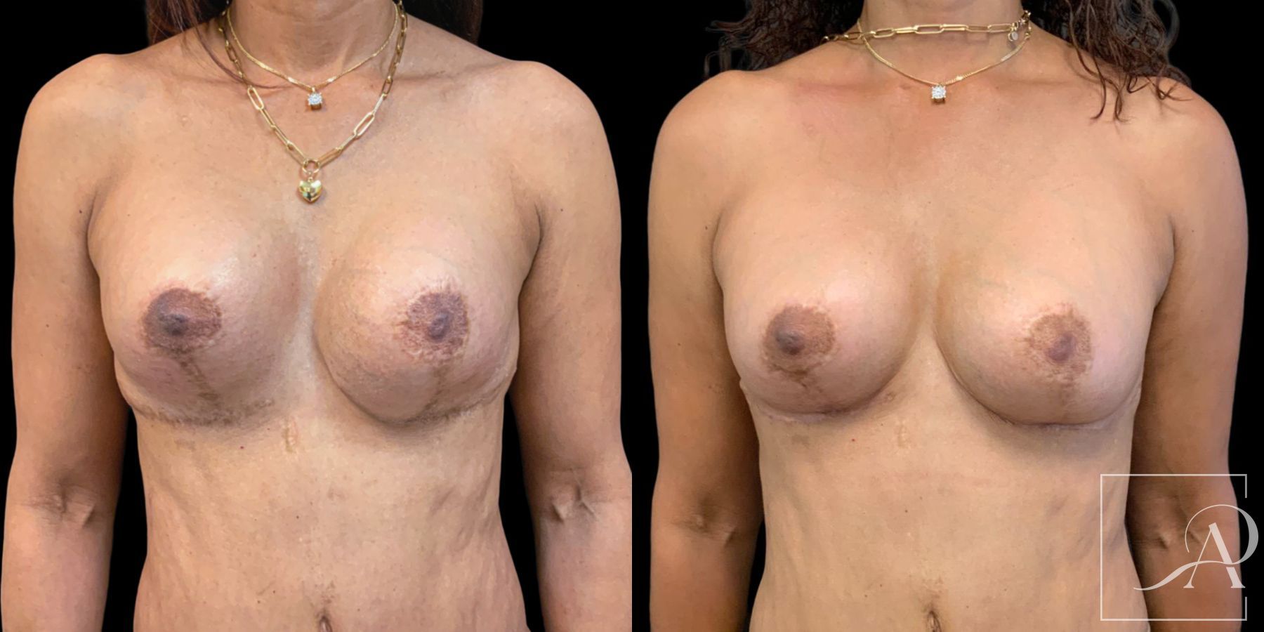 Before and after Capsulectomy case 46764 - Angle 2