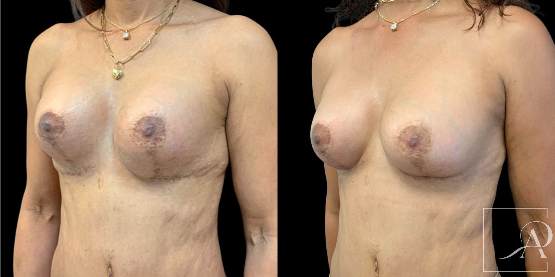 Before and after Capsulectomy case 46764