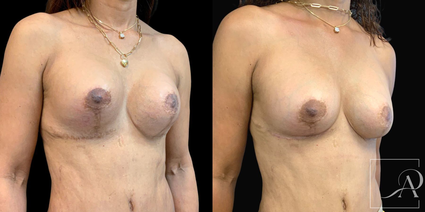 Before and after Capsulectomy case 46764 - Angle 3