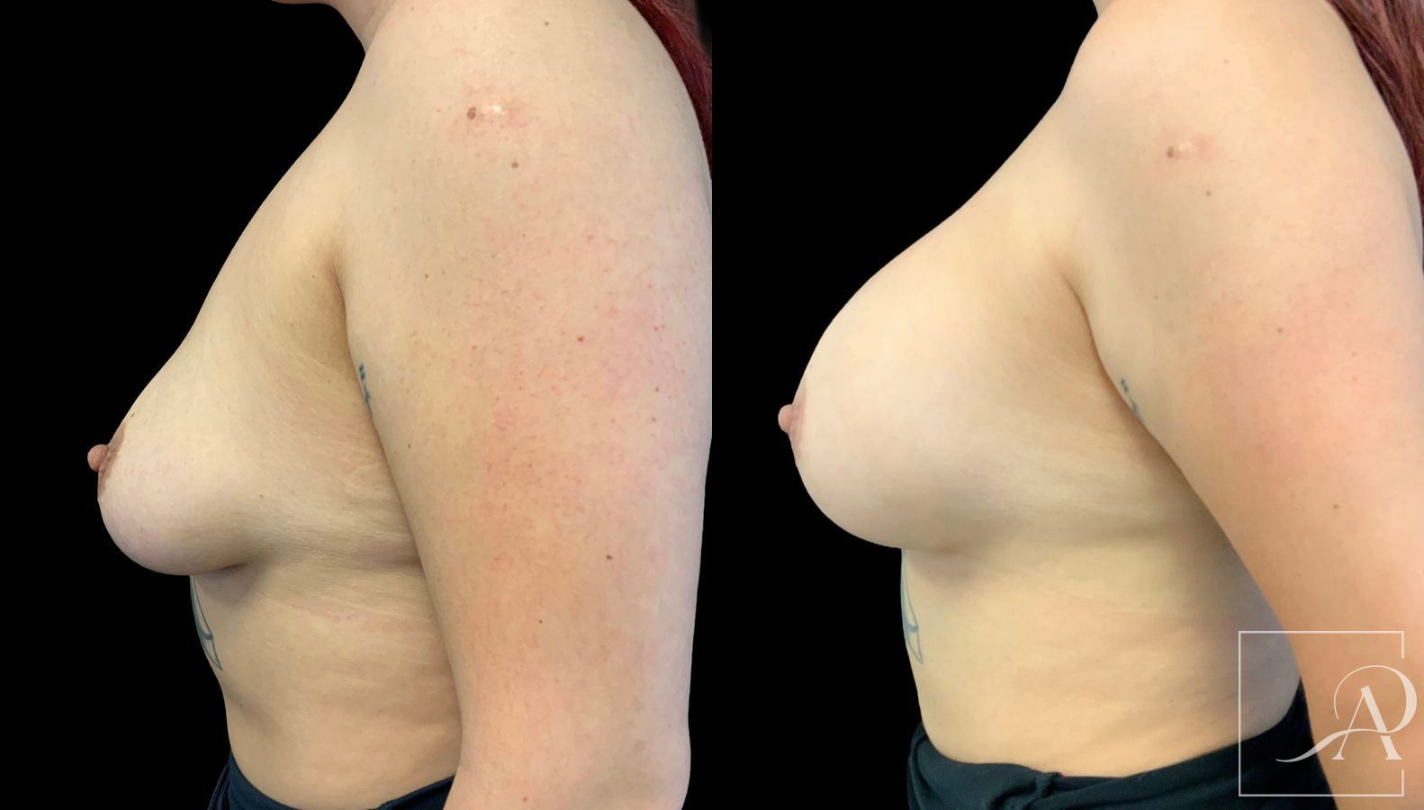 Before and after Cosmetic Breast Revision case 43378
