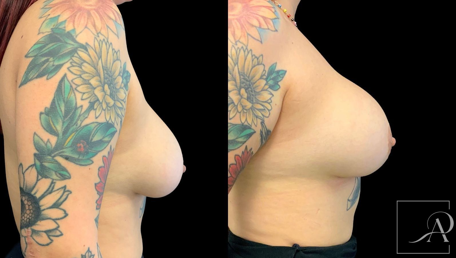 Before and after Cosmetic Breast Revision case 43378 - Angle 5