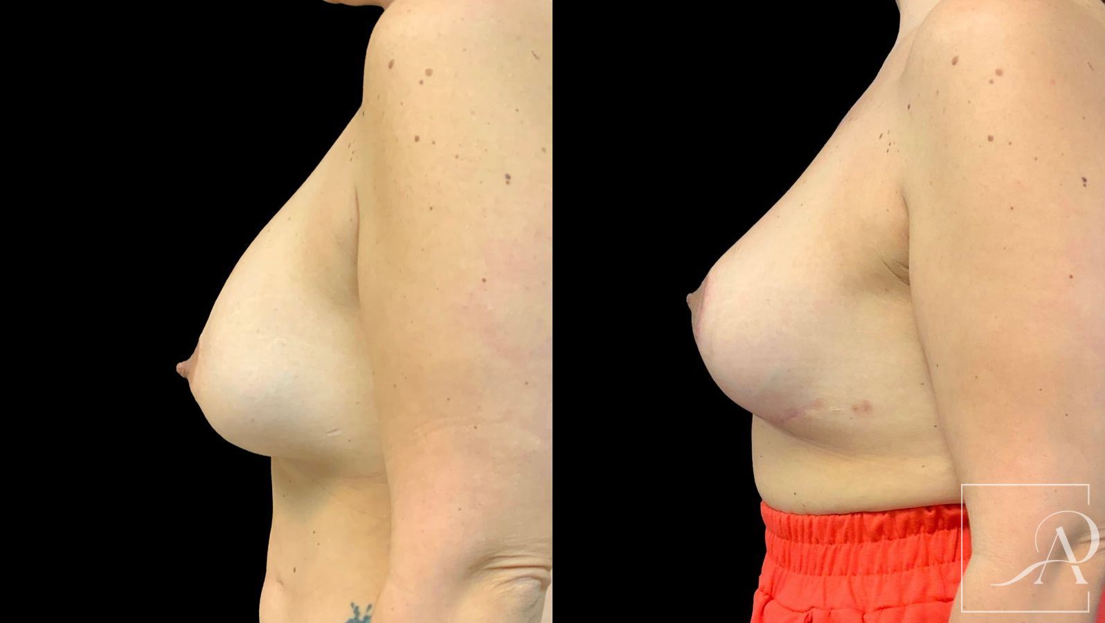 Before and after Cosmetic Breast Revision case 43380