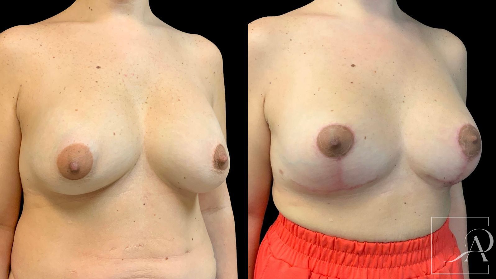 Before and after Cosmetic Breast Revision case 43380 - Angle 4