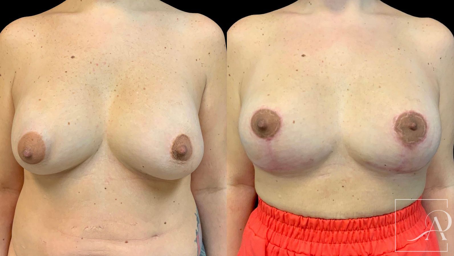 Before and after Cosmetic Breast Revision case 43380 - Angle 3