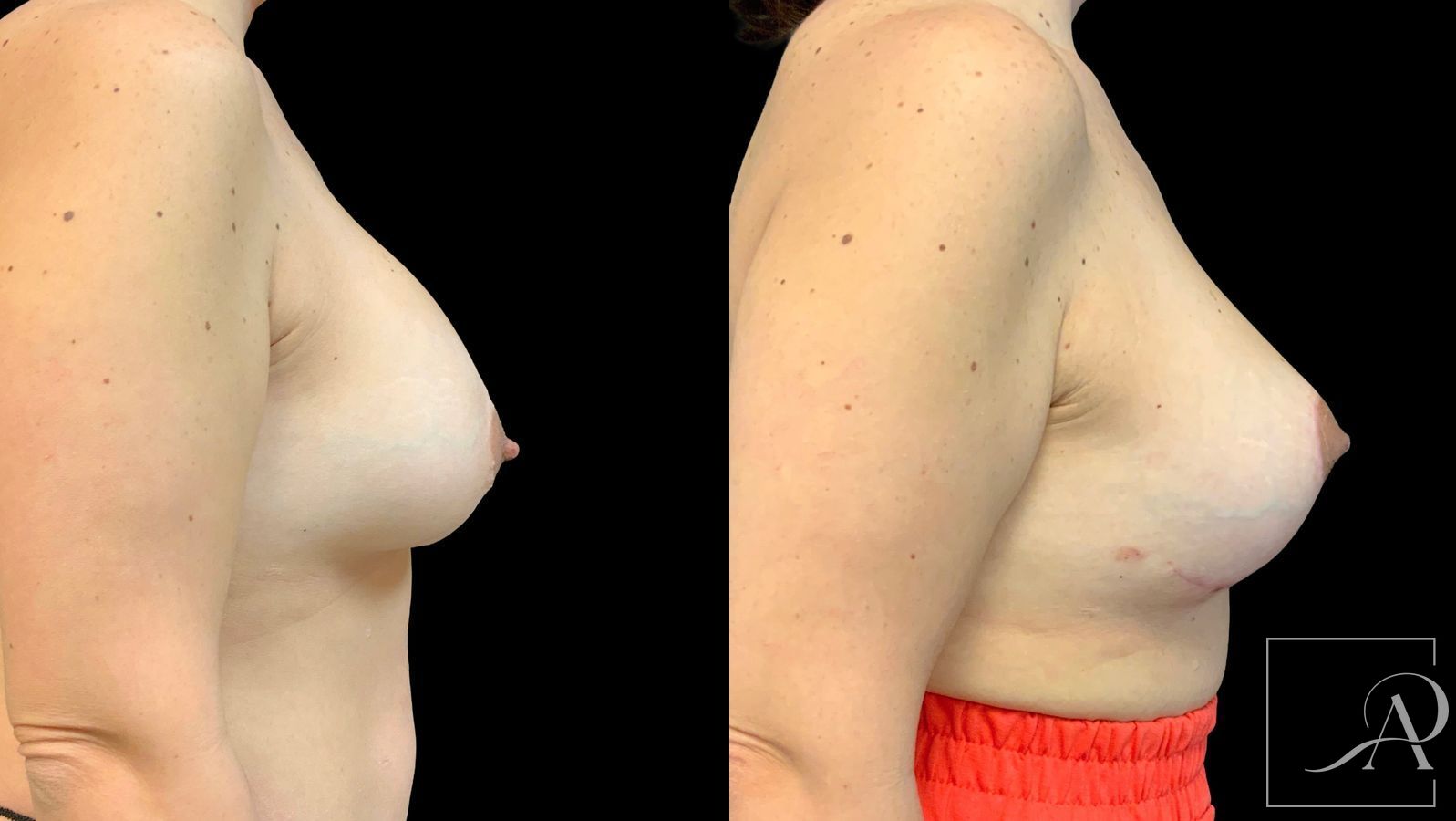 Before and after Cosmetic Breast Revision case 43380 - Angle 5