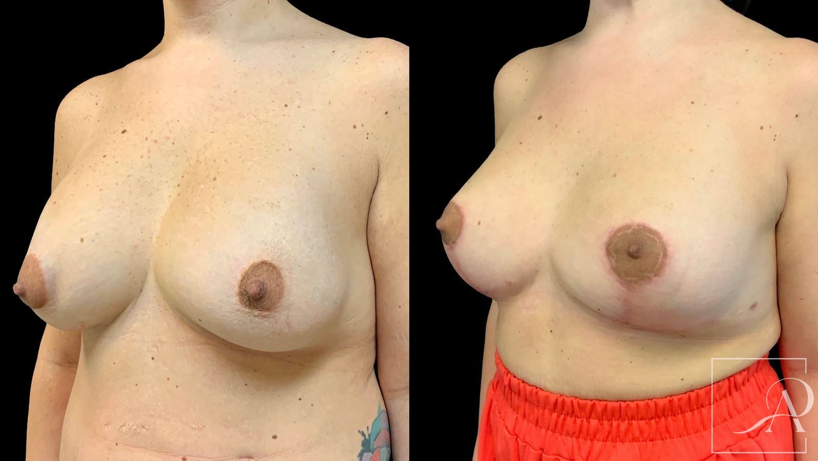 Before and after Cosmetic Breast Revision case 43380 - Angle 2