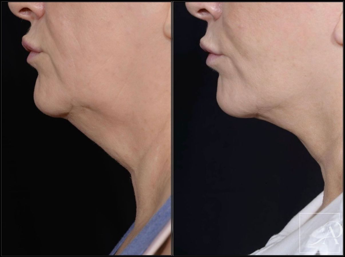 Before and after Facelift case 43372 - Angle 6