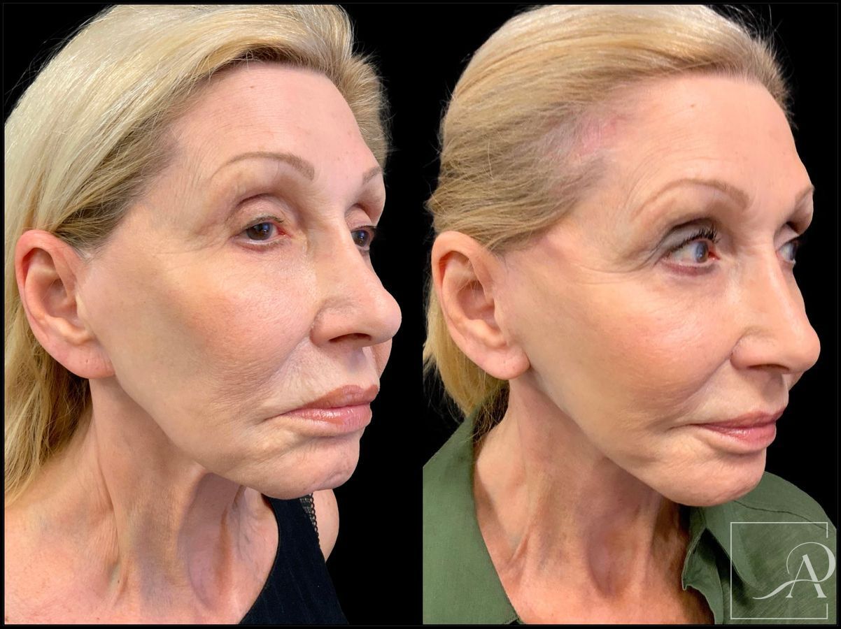 Before and after Facelift case 43374 - Angle 4