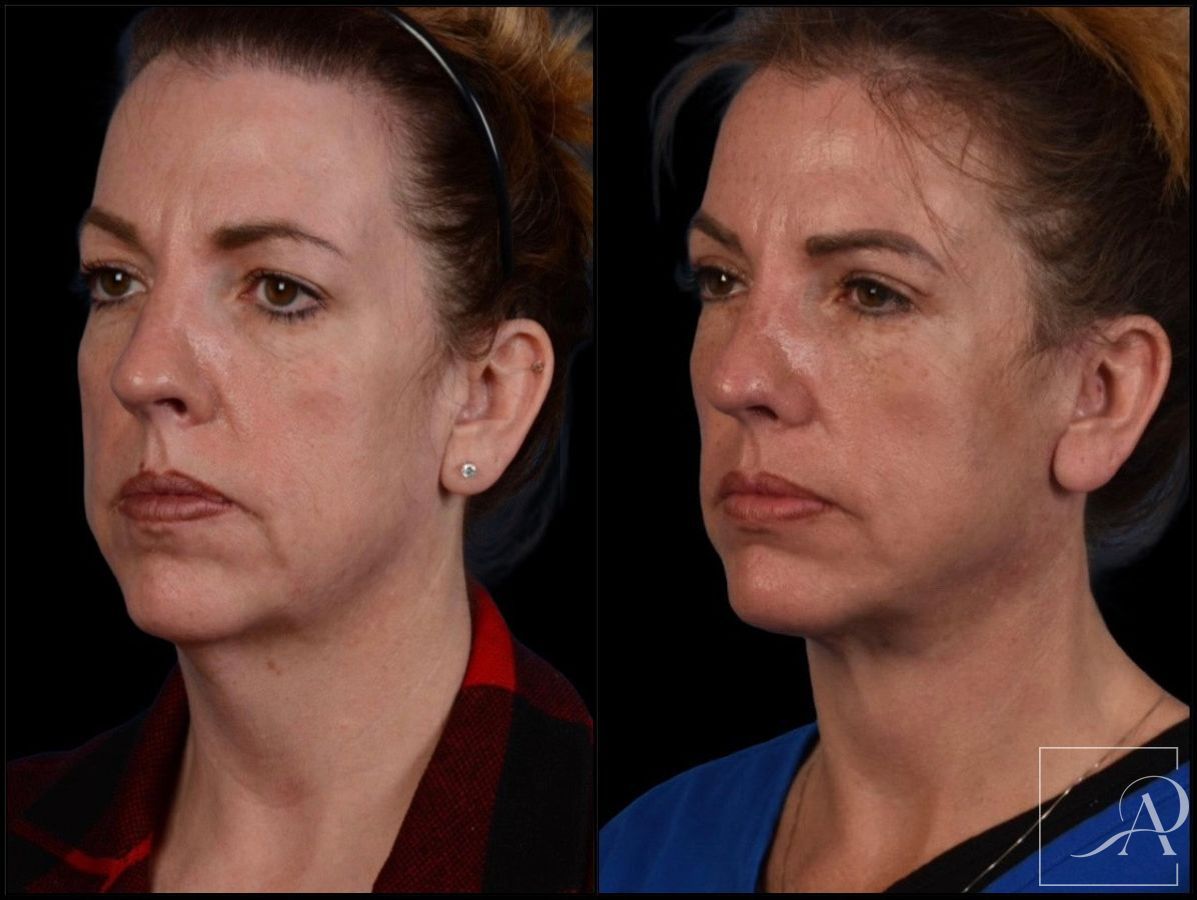 Before and after Facelift case 43375 - Angle 2