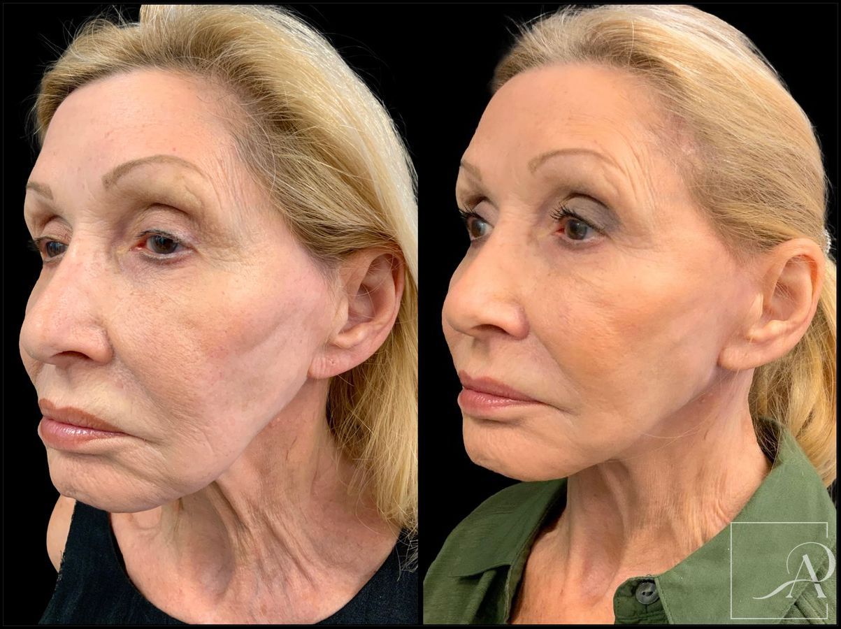 Before and after Facelift case 43374 - Angle 2