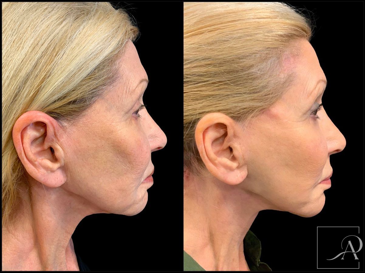 Before and after Facelift case 43374 - Angle 5