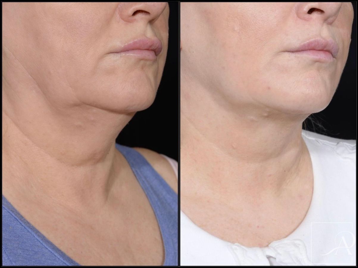 Before and after Facelift case 43372 - Angle 8