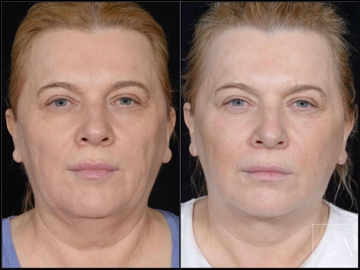 Before and after Facelift case 43372 - Angle 3
