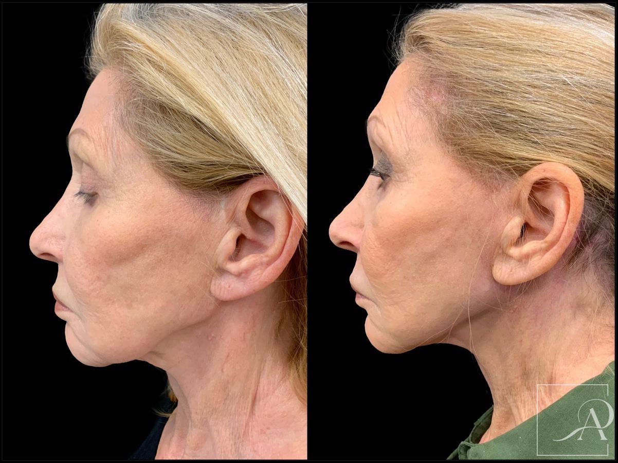 Before and after Facelift case 43374