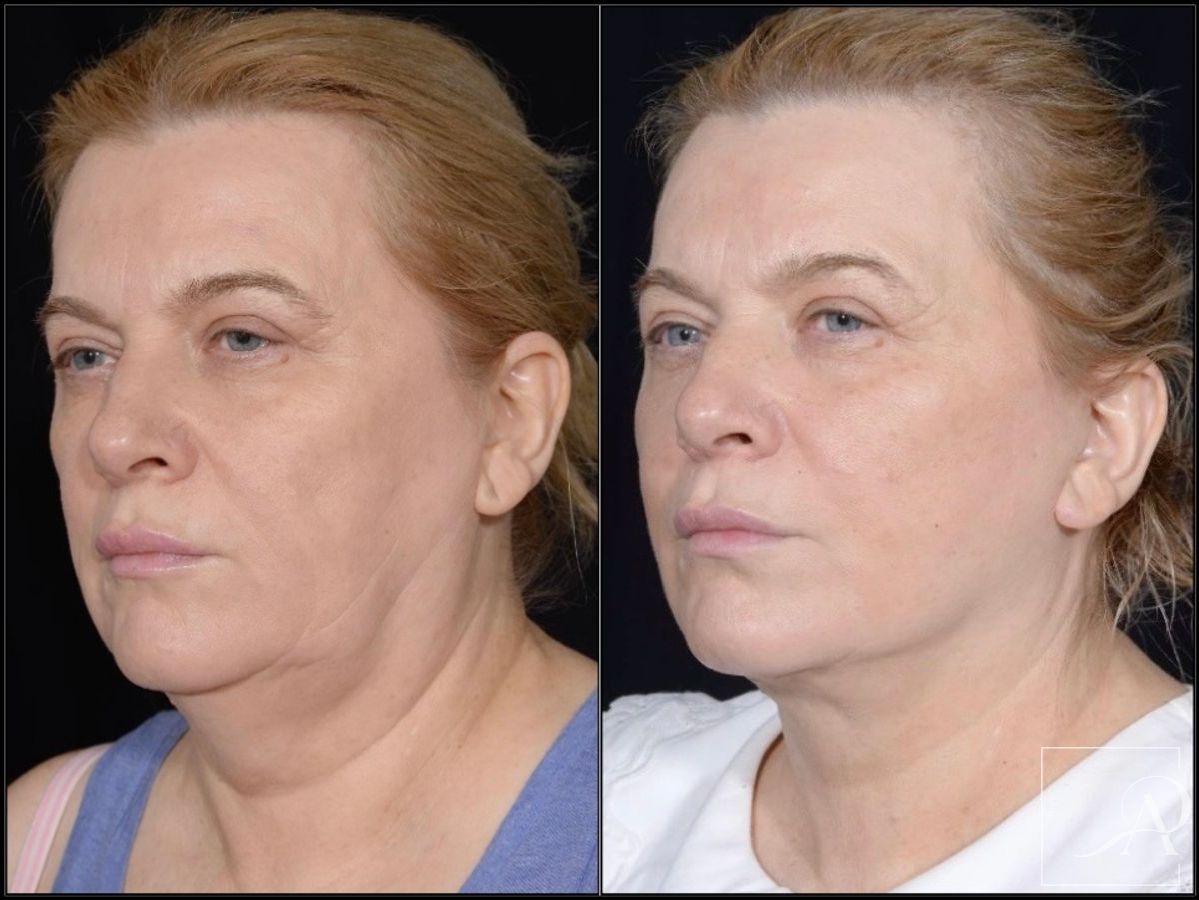 Before and after Facelift case 43372 - Angle 2