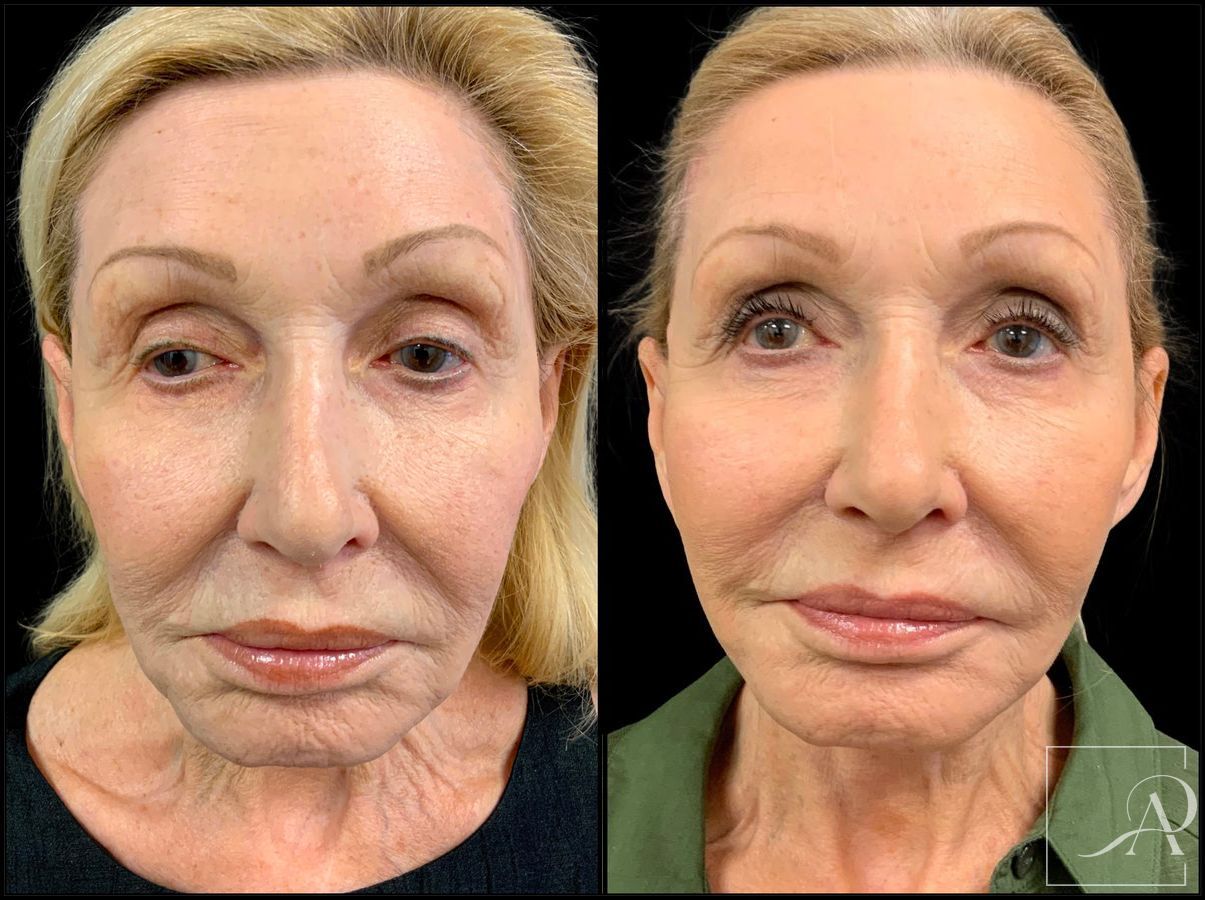 Before and after Facelift case 43374 - Angle 3