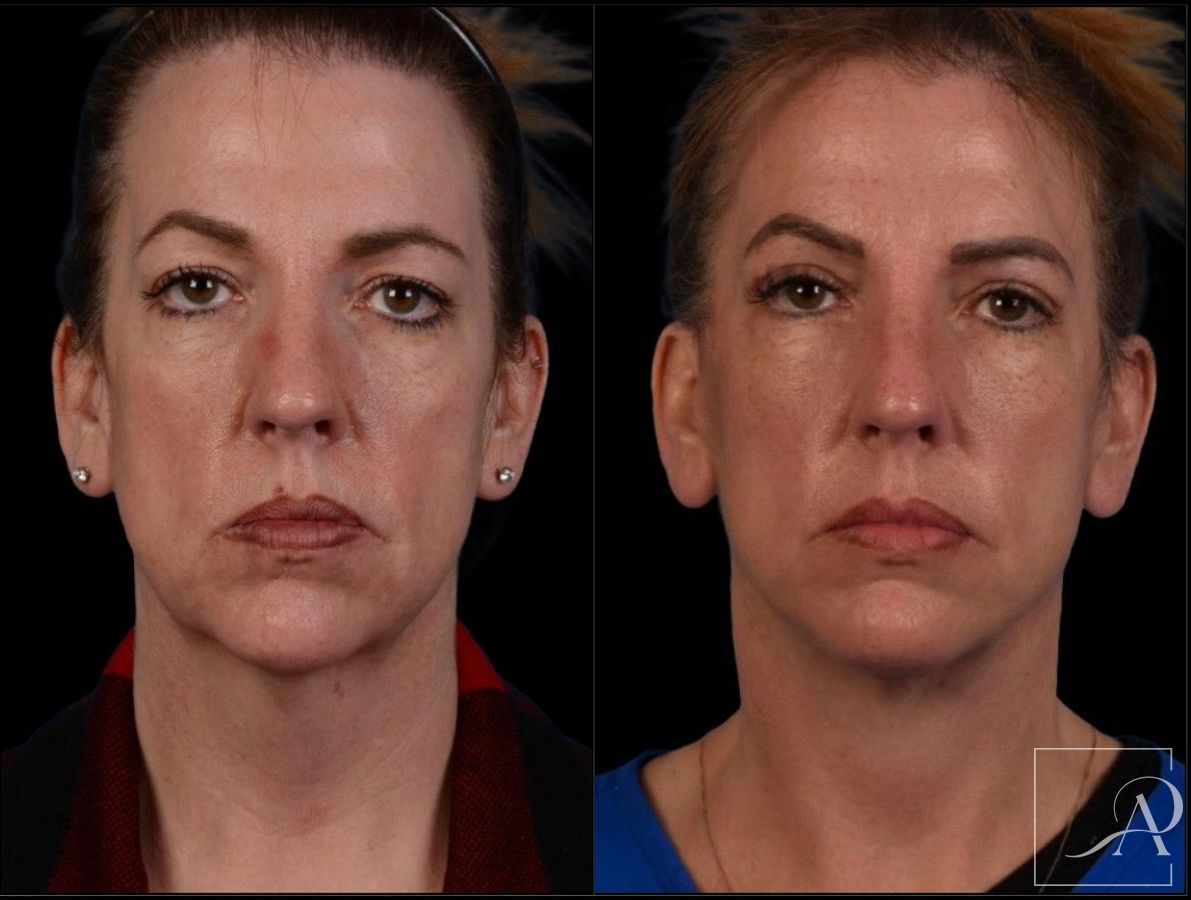 Before and after Facelift case 43375 - Angle 4