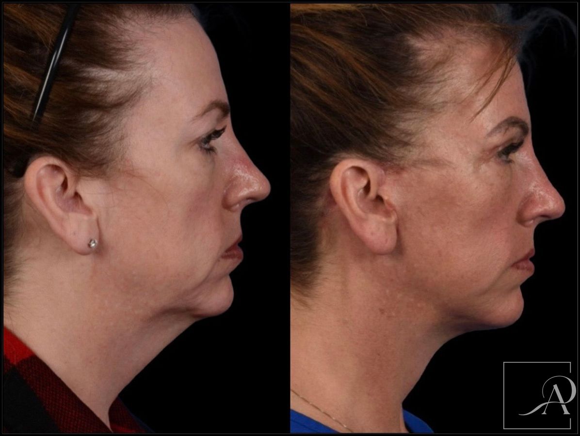 Before and after Facelift case 43375 - Angle 6