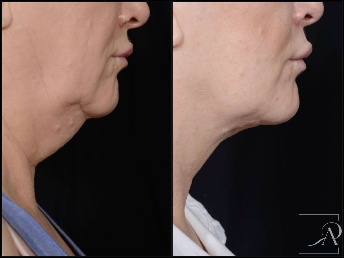 Before and after Facelift case 43372 - Angle 5