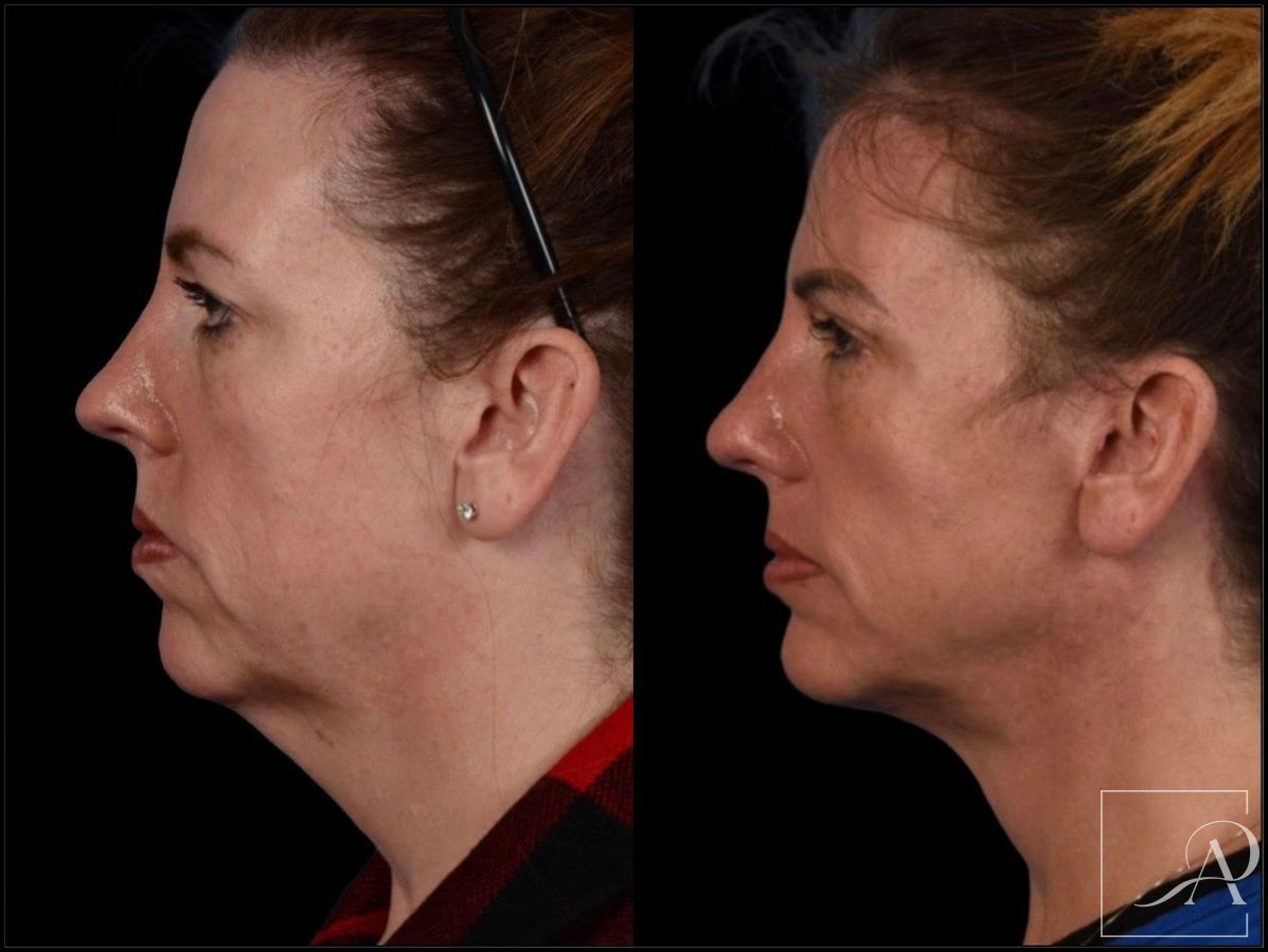 Before and after Facelift case 43375
