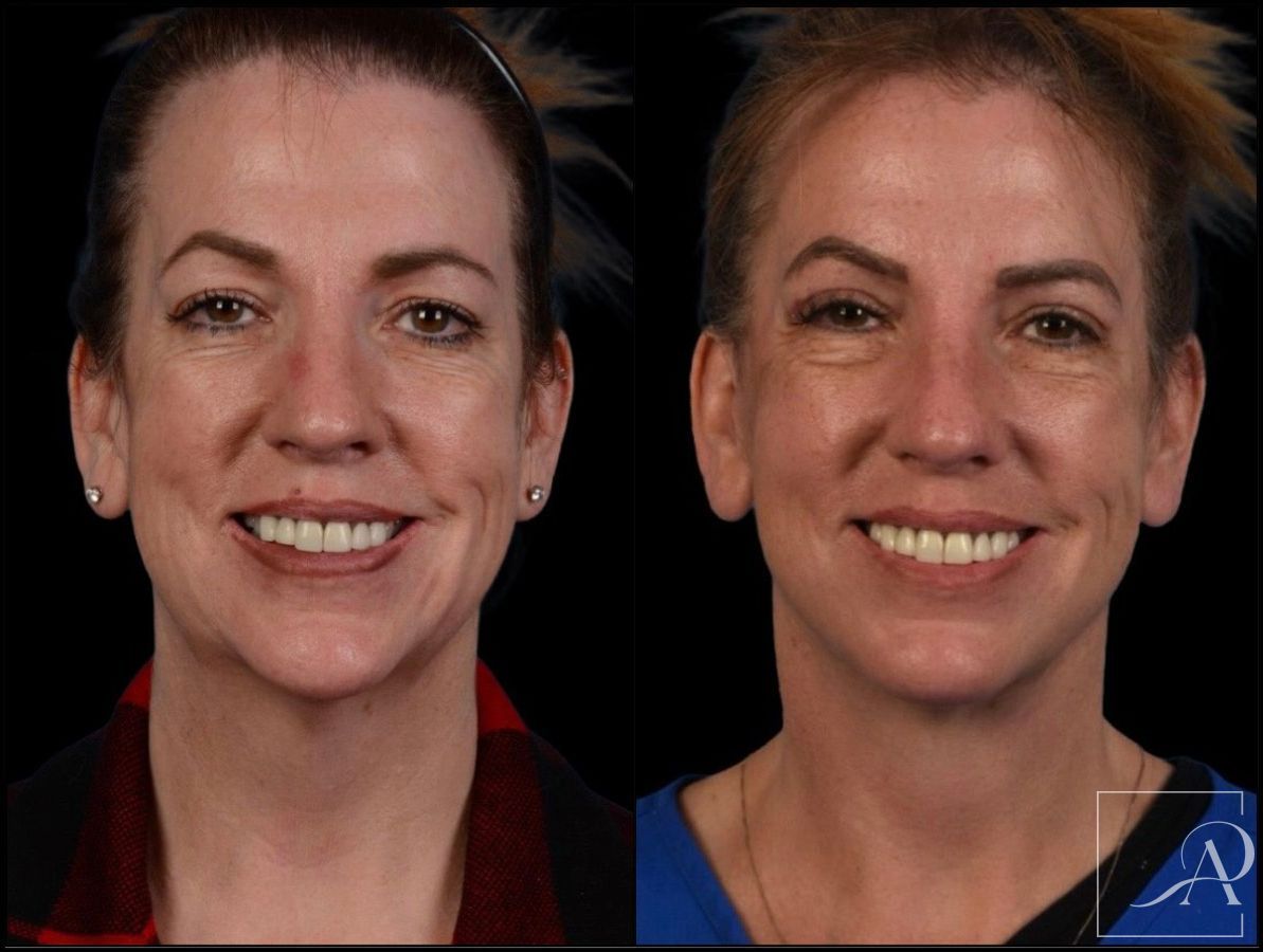 Before and after Facelift case 43375 - Angle 3