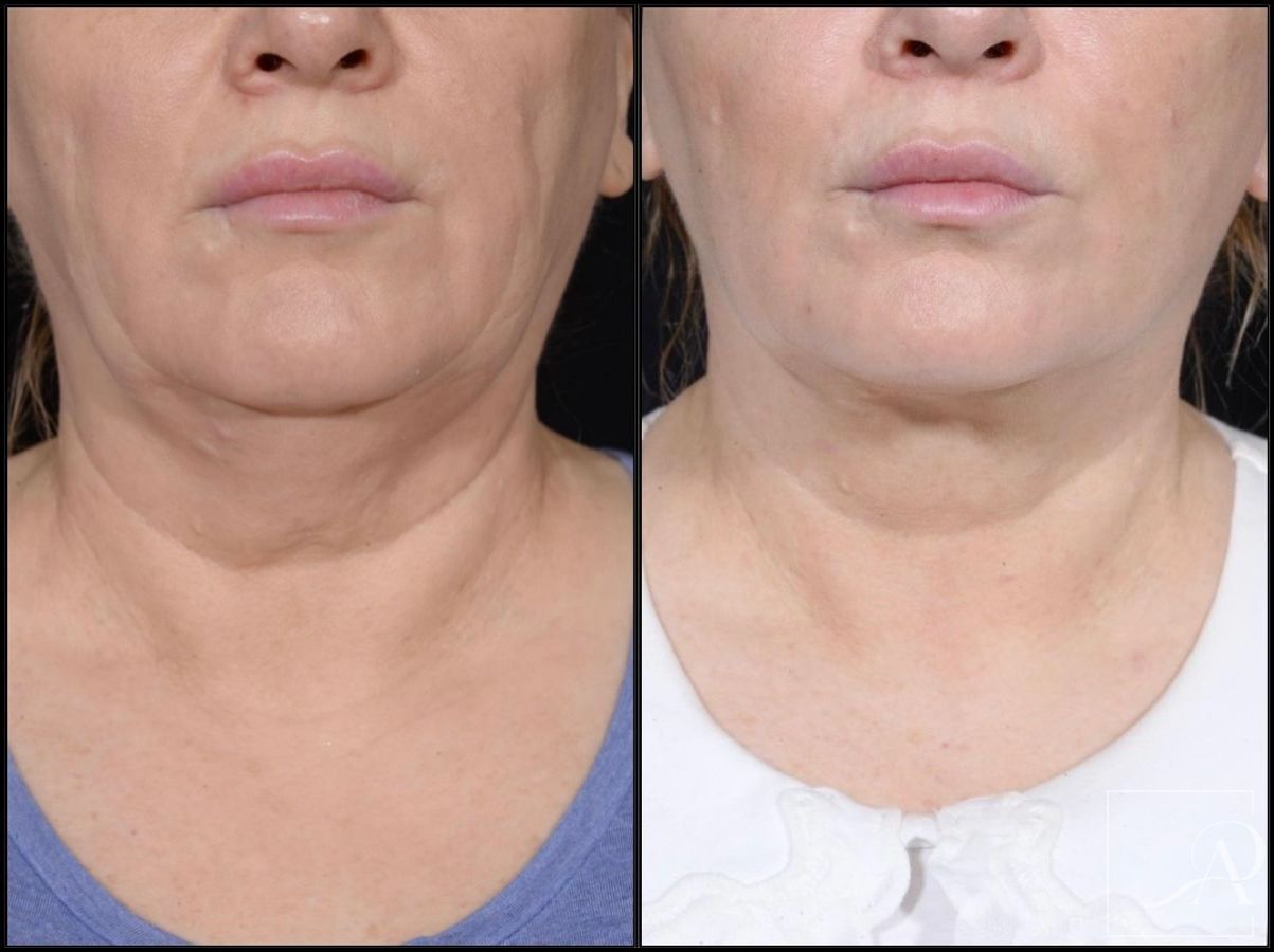 Before and after Facelift case 43372 - Angle 9