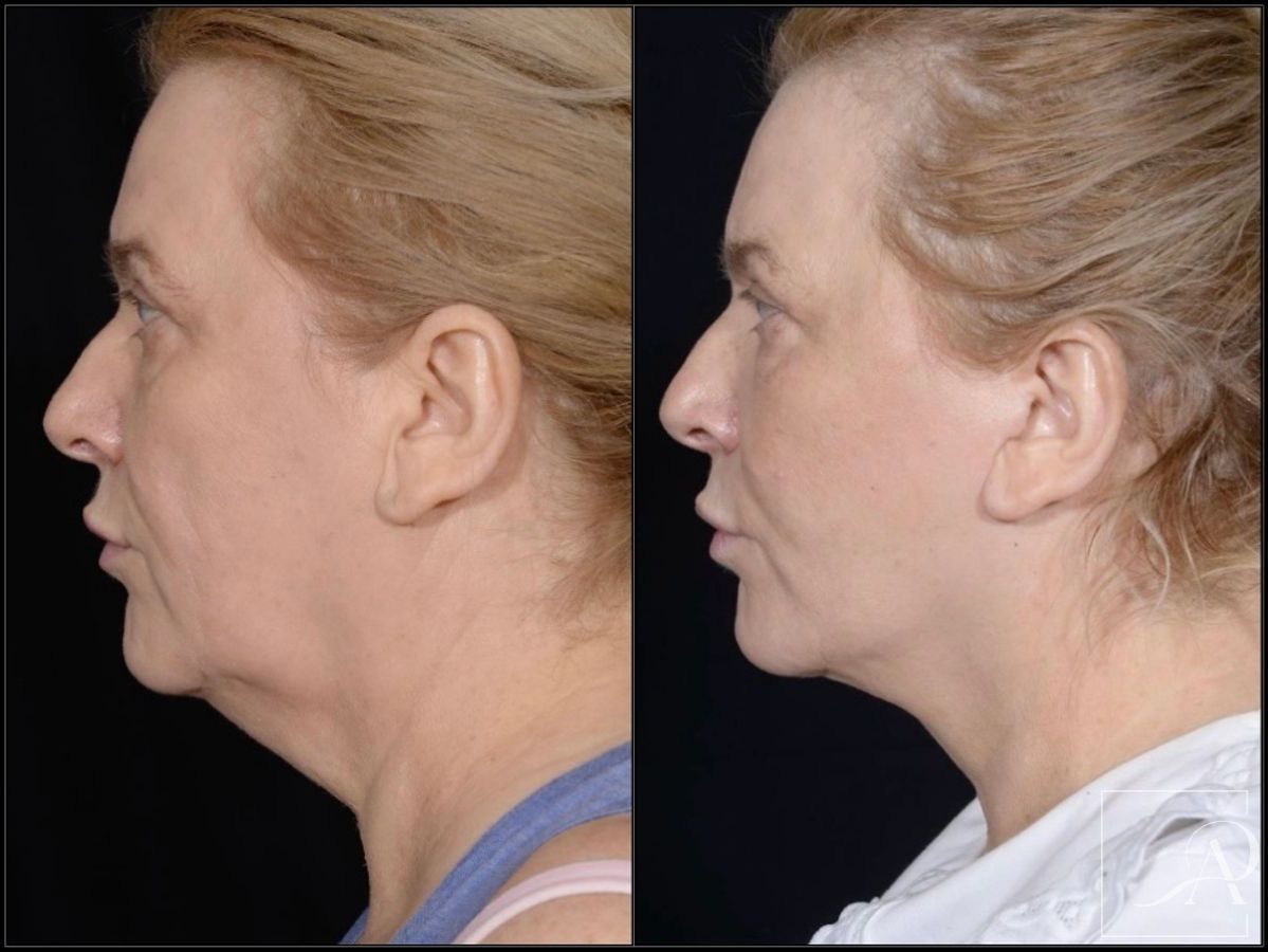 Before and after Facelift case 43372