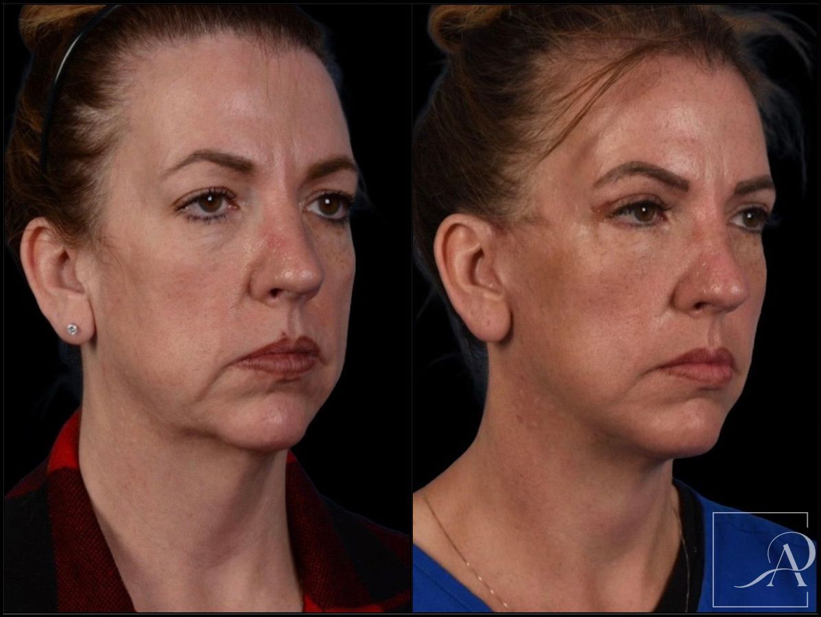 Before and after Facelift case 43375 - Angle 5