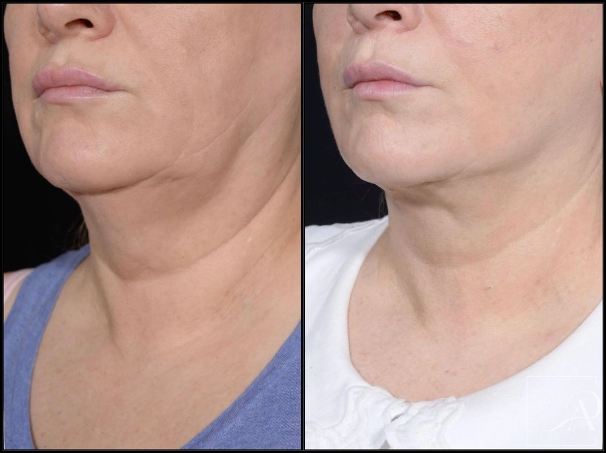Before and after Facelift case 43372 - Angle 7