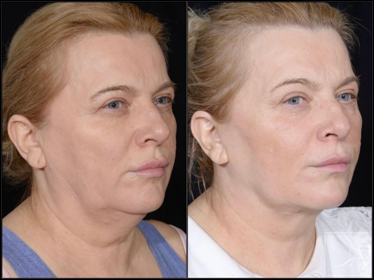 Before and after Facelift case 43372 - Angle 4