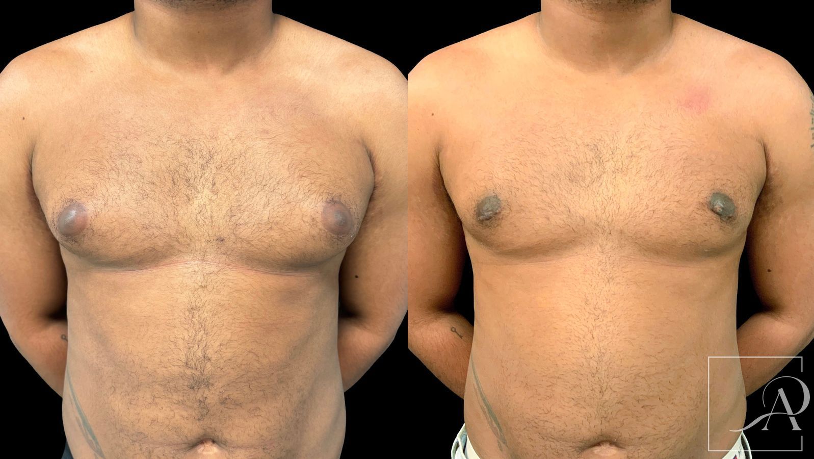 Before and after Gynecomastia case 43369 - Angle 3