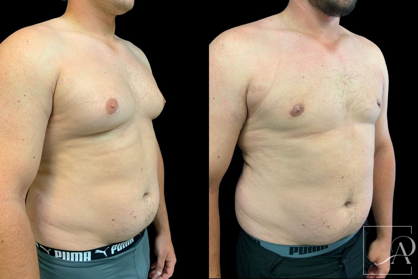Before and after Gynecomastia case 46132 - Angle 4