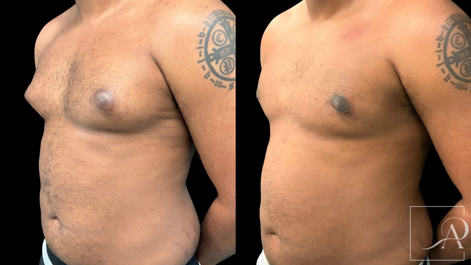 Before and after Gynecomastia case 43369 - Angle 2