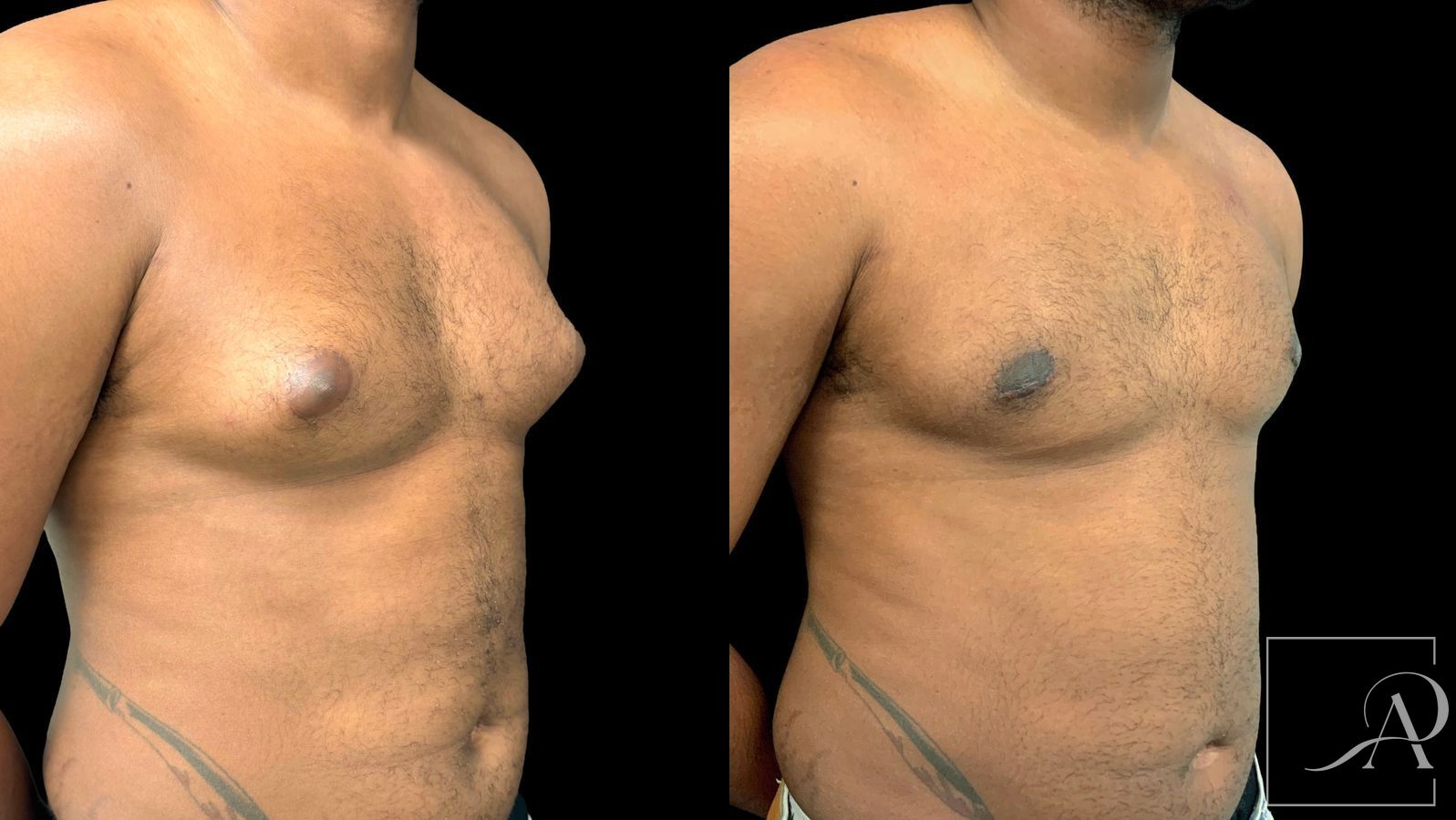 Before and after Gynecomastia case 43369 - Angle 4