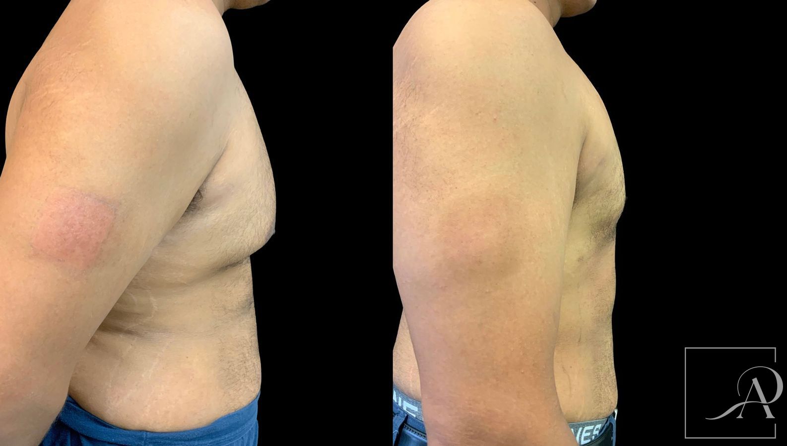 Before and after Gynecomastia case 43367 - Angle 5