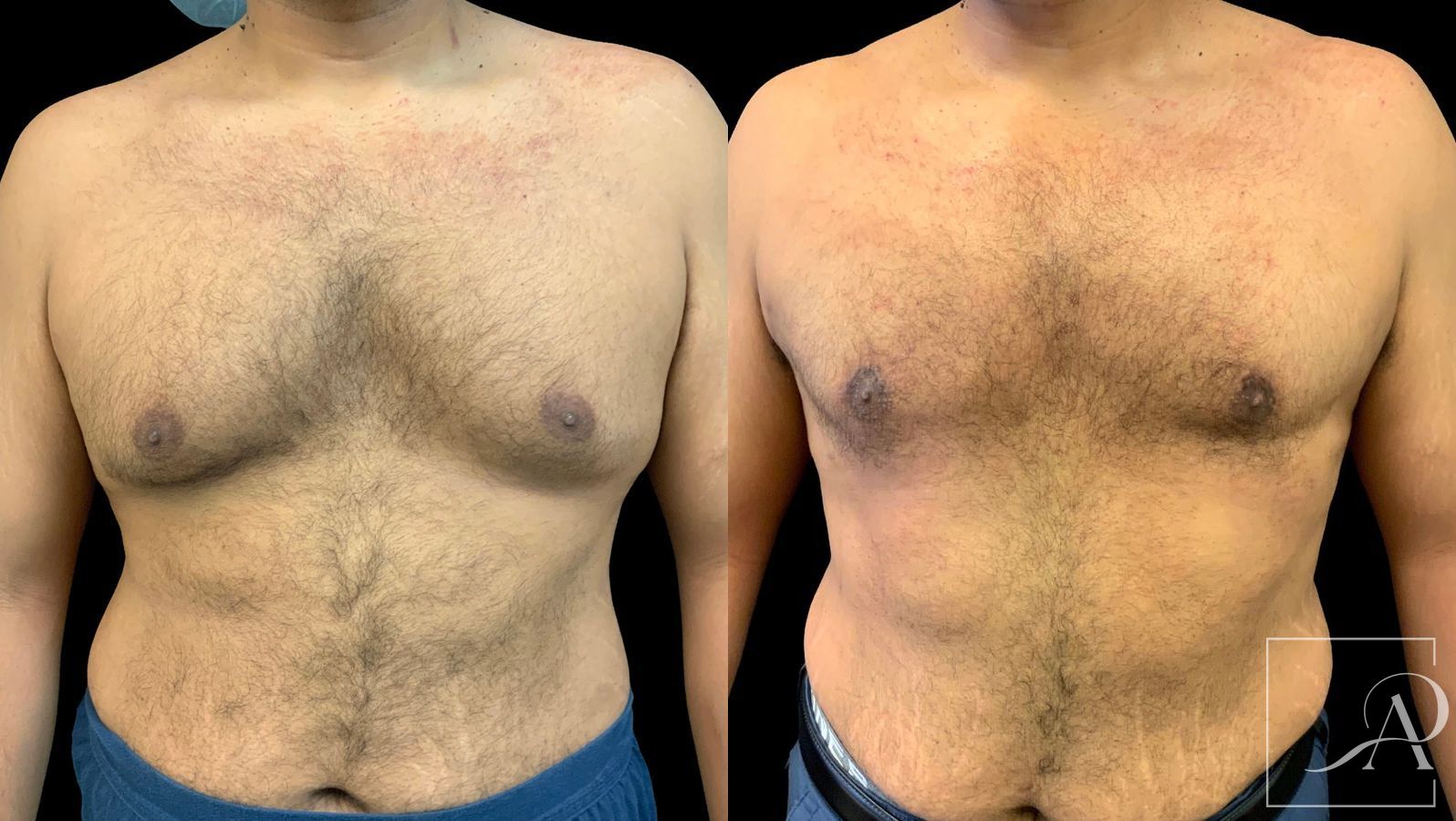 Before and after Gynecomastia case 43367 - Angle 3